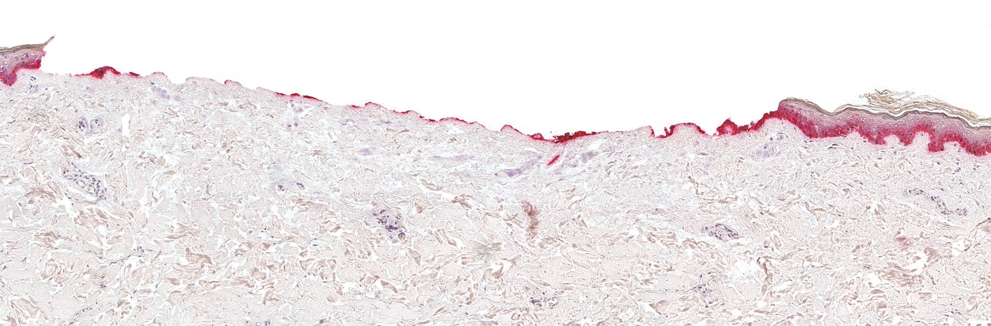 Skin Test Skin Regeneration - Skin de-epidermized - Day 0 - CK14